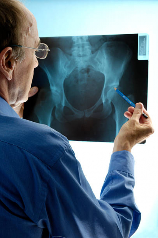 Cirurgia de Ortopedia Agendar Sumaré - Cirurgia Ortopedica para Idosos