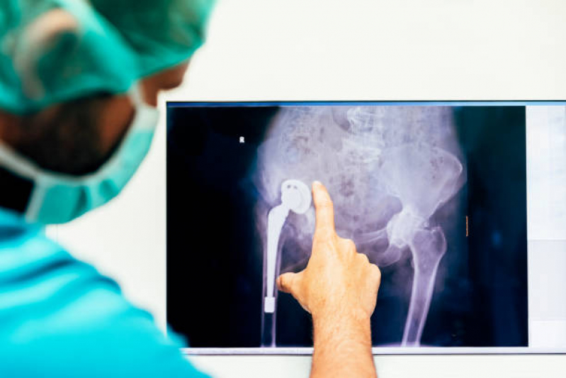 Cirurgia Ortopedica para Idosos Saúde - Cirurgia Ortopedica em Idosos