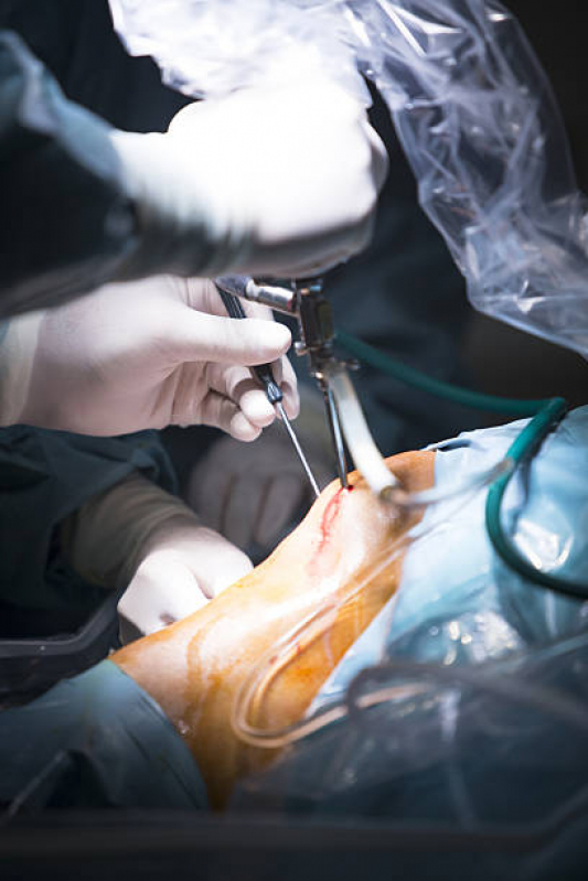 Cirurgia Ortopedica para o Pé Sorocaba - Cirurgia Ortopedica em Idosos