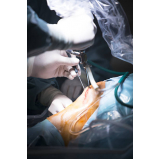 cirurgia ortopedica para o pé Diadema